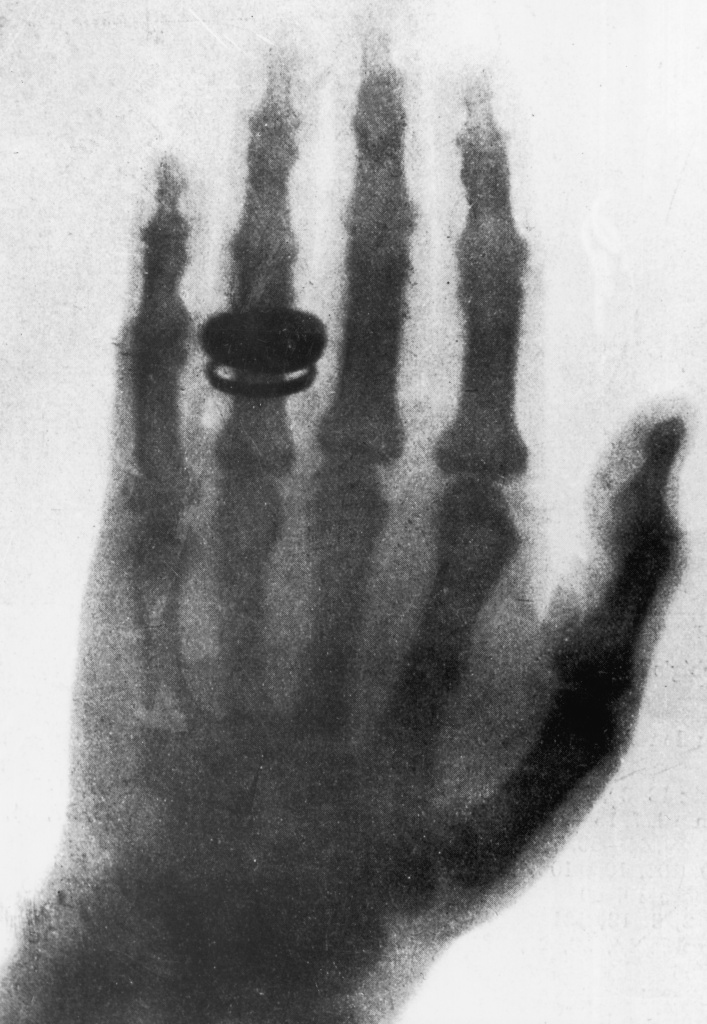 Рука жены Вильгельма Конрада Рентгена. Один из первых рентгеновских снимков, сделан немецким физиком в январе 1896 года