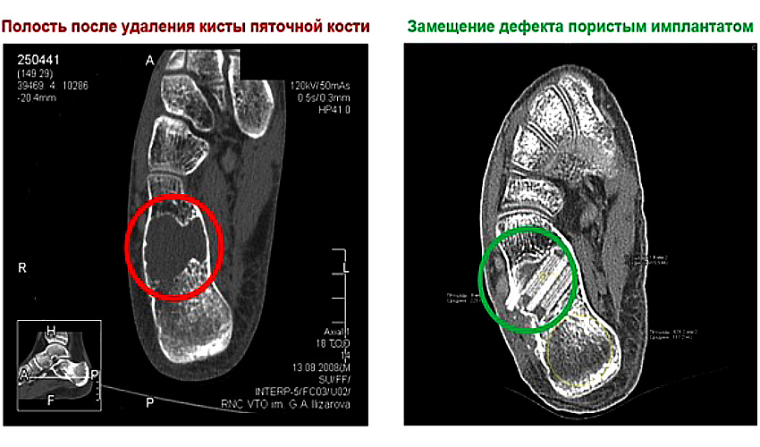 Долина смерти для искусственных костей